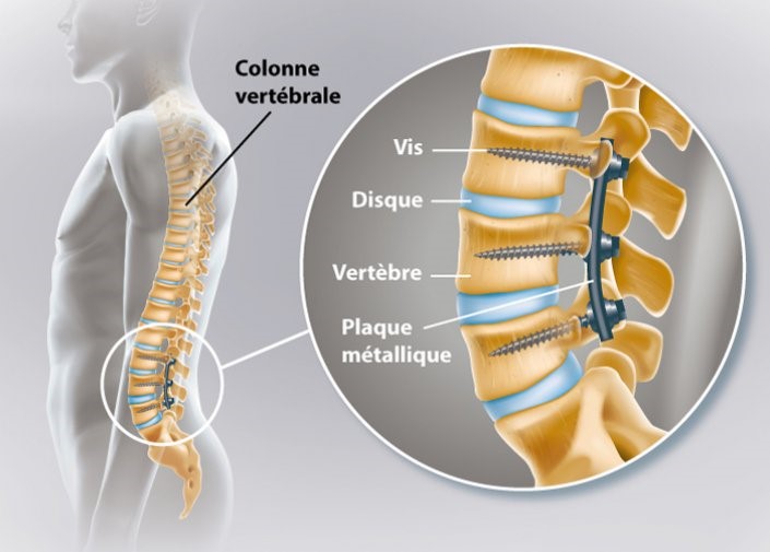 Arthrod se Lombaire Lyon Neurochirurgie M dip le Villeurbanne